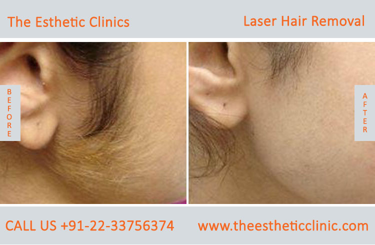 Permanent Laser Hair Removal Treatment before after photos in mumbai india (2)